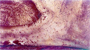 الإسهال الفيروسي — تآكل على السطح السفلي وجوانب اللسان